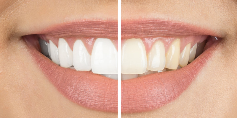 Cosmetic Dentistry in Kernersville, North Carolina