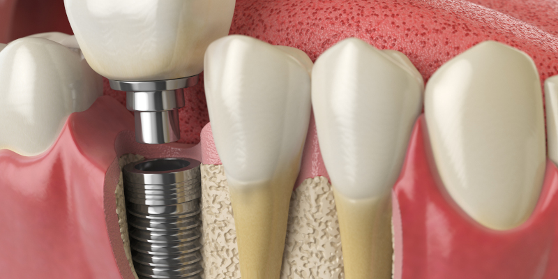Root Canal in Kernersville, North Carolina