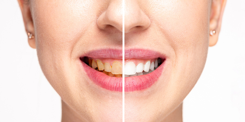 3 Advantages to Professional Teeth Whitening