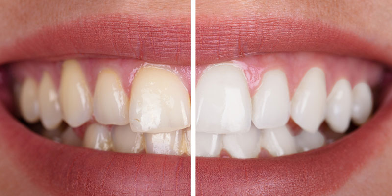 3 Reasons You Should Try Teeth Whitening
