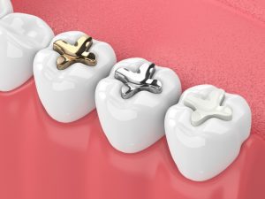 Which Kind of Fillings Would Be Best for You?