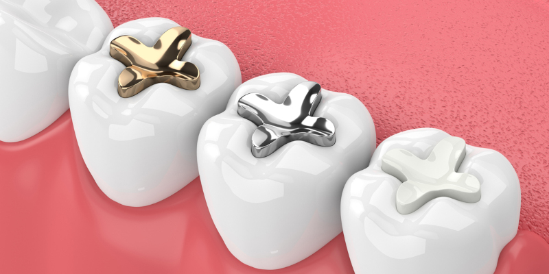 Which Kind of Fillings Would Be Best for You?