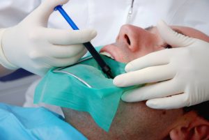 3 Signs You Might Need a Root Canal