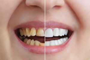 Cosmetic Dentistry Will Restore Your Beautiful Smile