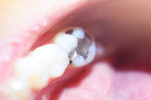 Dental Fillings are the Most Common Dental Procedure