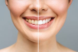 Get a Brighter Smile With Teeth Whitening