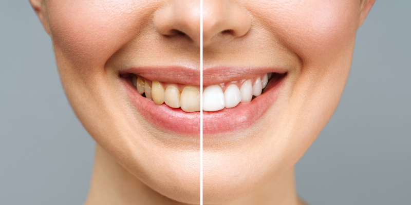 Get a Brighter Smile With Teeth Whitening