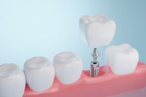 What You Need To Know If You're Considering Getting Dental Implants