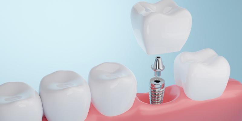What You Need To Know If You're Considering Getting Dental Implants
