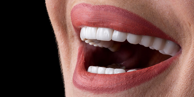 Are Veneers a Good Idea for You?