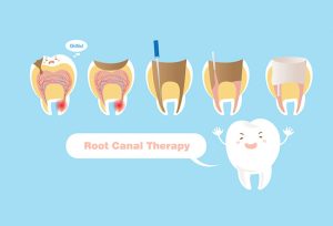 How Does Root Canal Therapy Work?