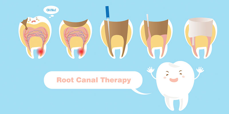 How Does Root Canal Therapy Work?