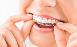 Three Common Myths About Teeth Whitening