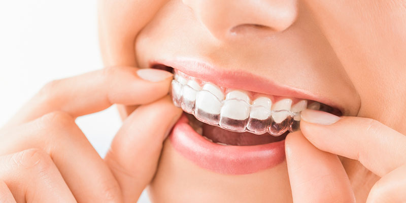 Three Common Myths About Teeth Whitening