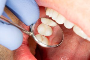 Are Fillings the Best Solution for Small Cavities?