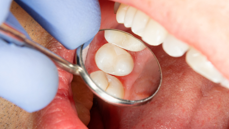 Are Fillings the Best Solution for Small Cavities?