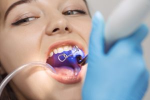 Dental Bonding and its Benefits to Your Smile