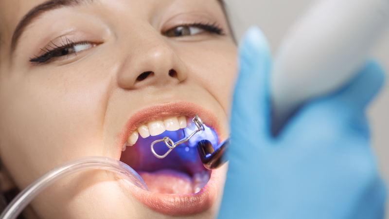 Dental Bonding and its Benefits to Your Smile