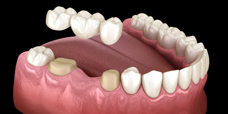 Crowns & Bridges: What’s the Difference, and Which Is Right for You?