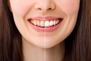 3 Cosmetic Dentistry Options to Improve Your Smile