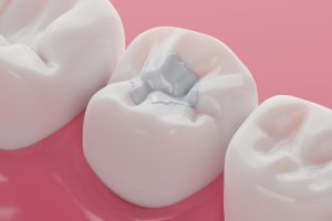 Pros and Cons of White Fillings