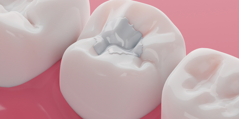 Pros and Cons of White Fillings