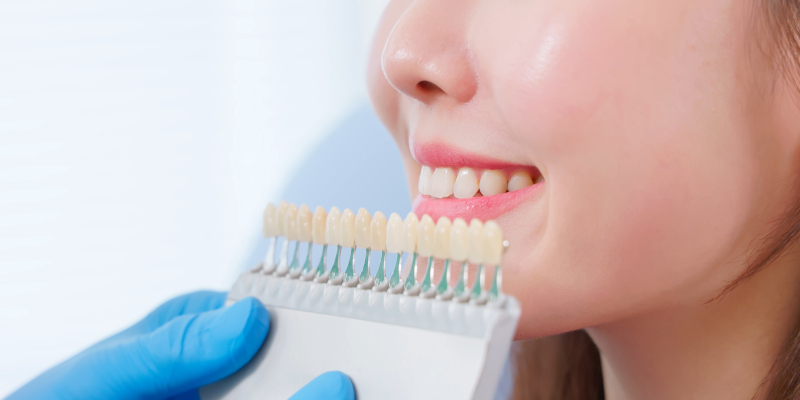 3 Things You Need to Know About Teeth Whitening